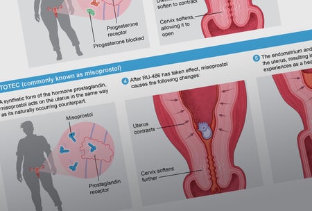 Detail of graphic shows how mifepristone and misoprostol act on the uterus and cervix to expel the embryo and endometrium.