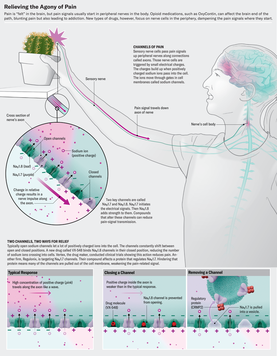 Illustration shows how sensory nerve cells pass pain signals to the brain via small electrical charges caused when positively charged sodium ions pass into the cell through sodium channels. Two approaches to dampening pain are shown. In one case a drug closes channels, in the other a drug facilitates removal of channels from the membrane.